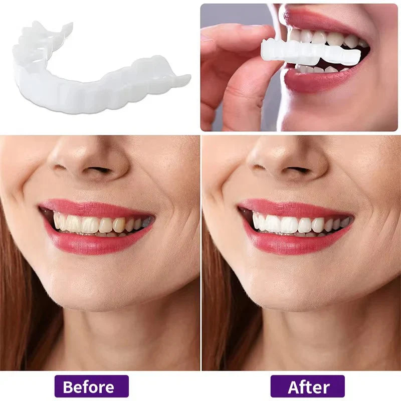 Snap on Smile Teeth Whitening veneers
