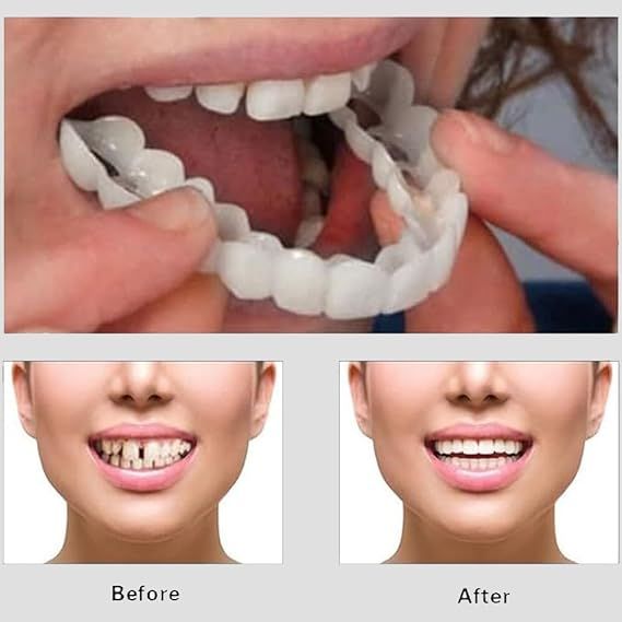 Instant Smile Snap-On Veneers