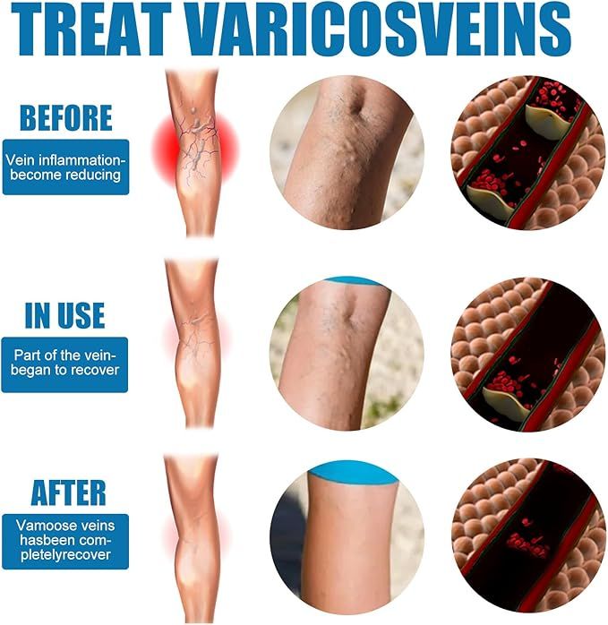 Vein Healing Varicose Veins Treatment Spray – Cooling Soothing Leg Relief & Skin Care Spray